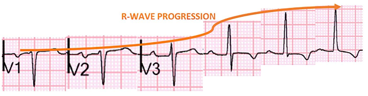 Downward Deflection Topic - The QRS Complex | 12-Lead ECG Certification Course | ACLS ...