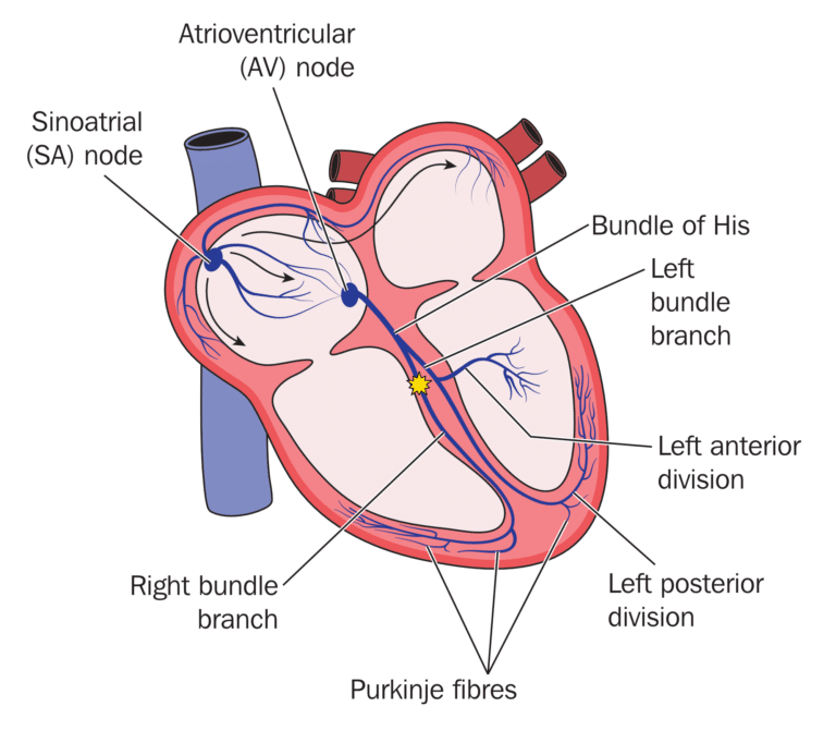 Topic - Complete Right Bundle-Branch Block | 12-Lead ECG Certification ...