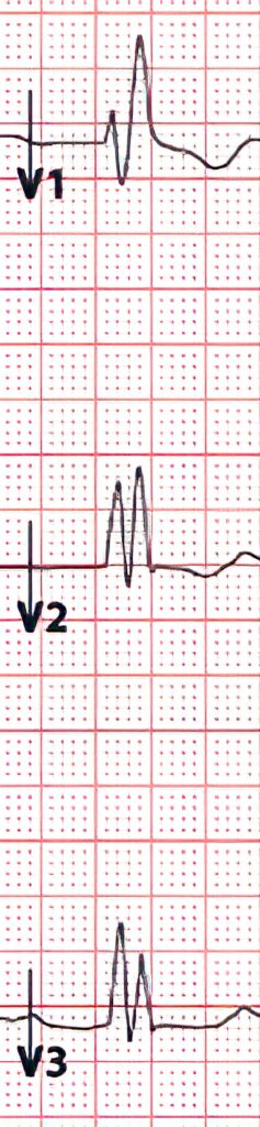 Topic - Rhythm Analysis | 12-Lead ECG Certification Course | ACLS ...