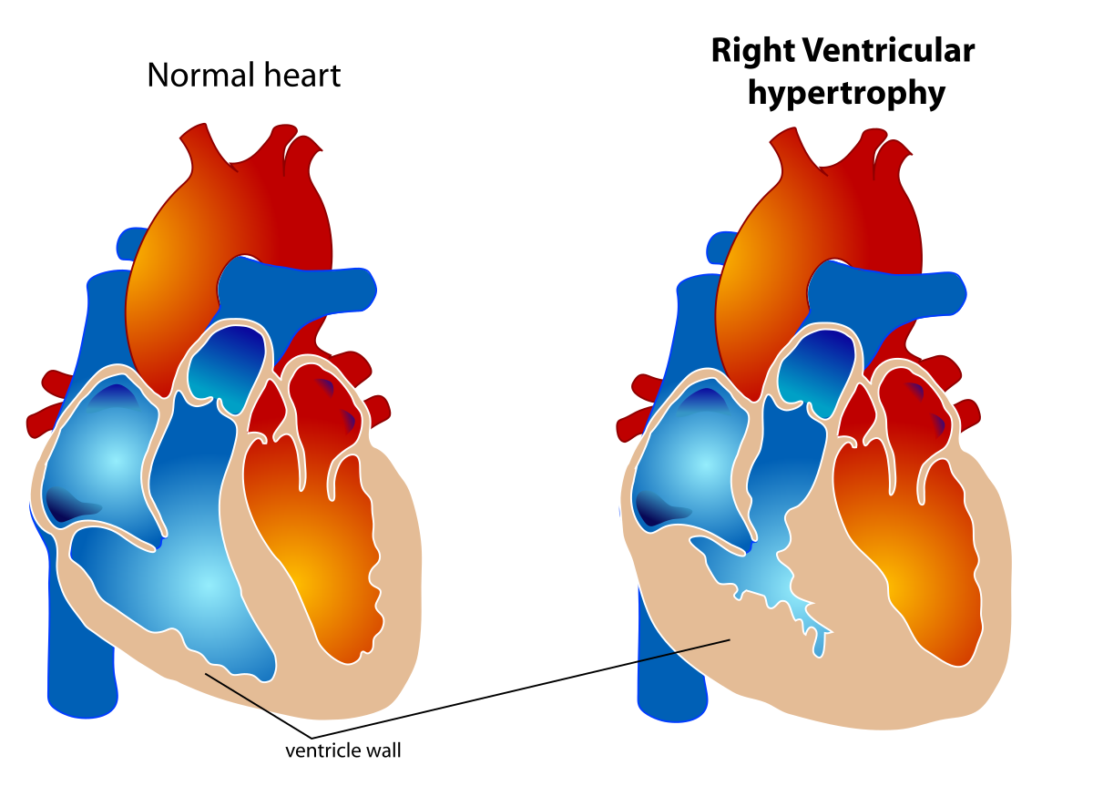Right ventricular hypertrophy.