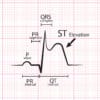 Topic - Changes in the ST Segment | 12 Lead ECG Course | ACLS ...