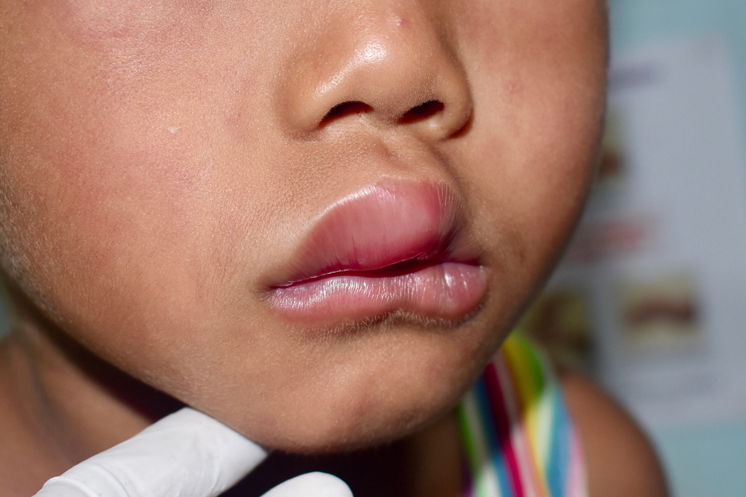Swollen lips due to allergic reaction.