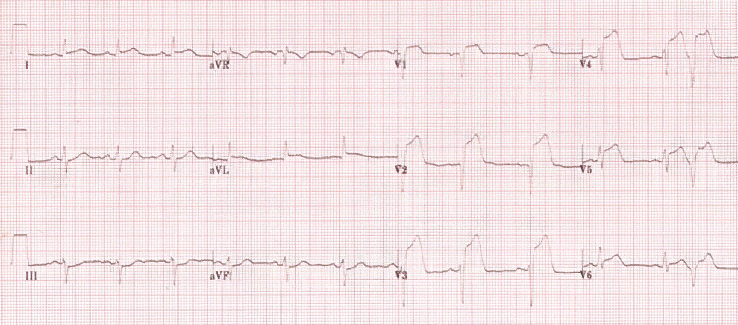 Table 2 ECG tracing.