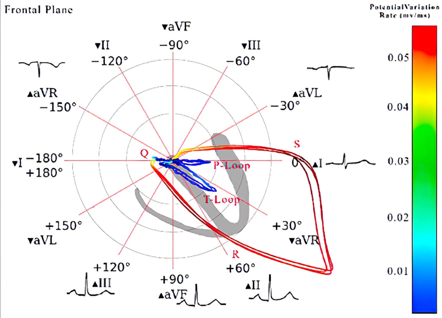 Topic - Localization of Q Wave Infarction | 12-Lead ECG Certification ...