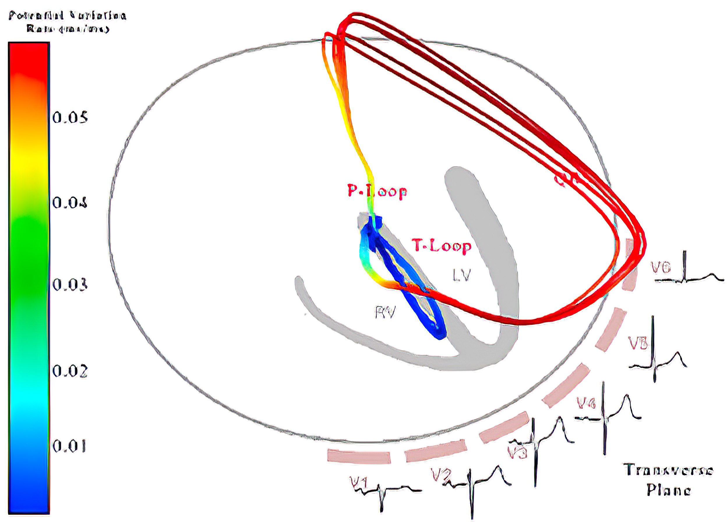 Vectorcardiograph (transverse plane) and electrocardiograph of complete RBBB and normal.