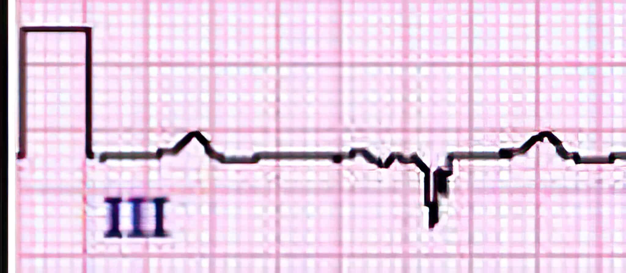 Topic - The QRS Complex | 12 Lead ECG Course | ACLS Certification ...