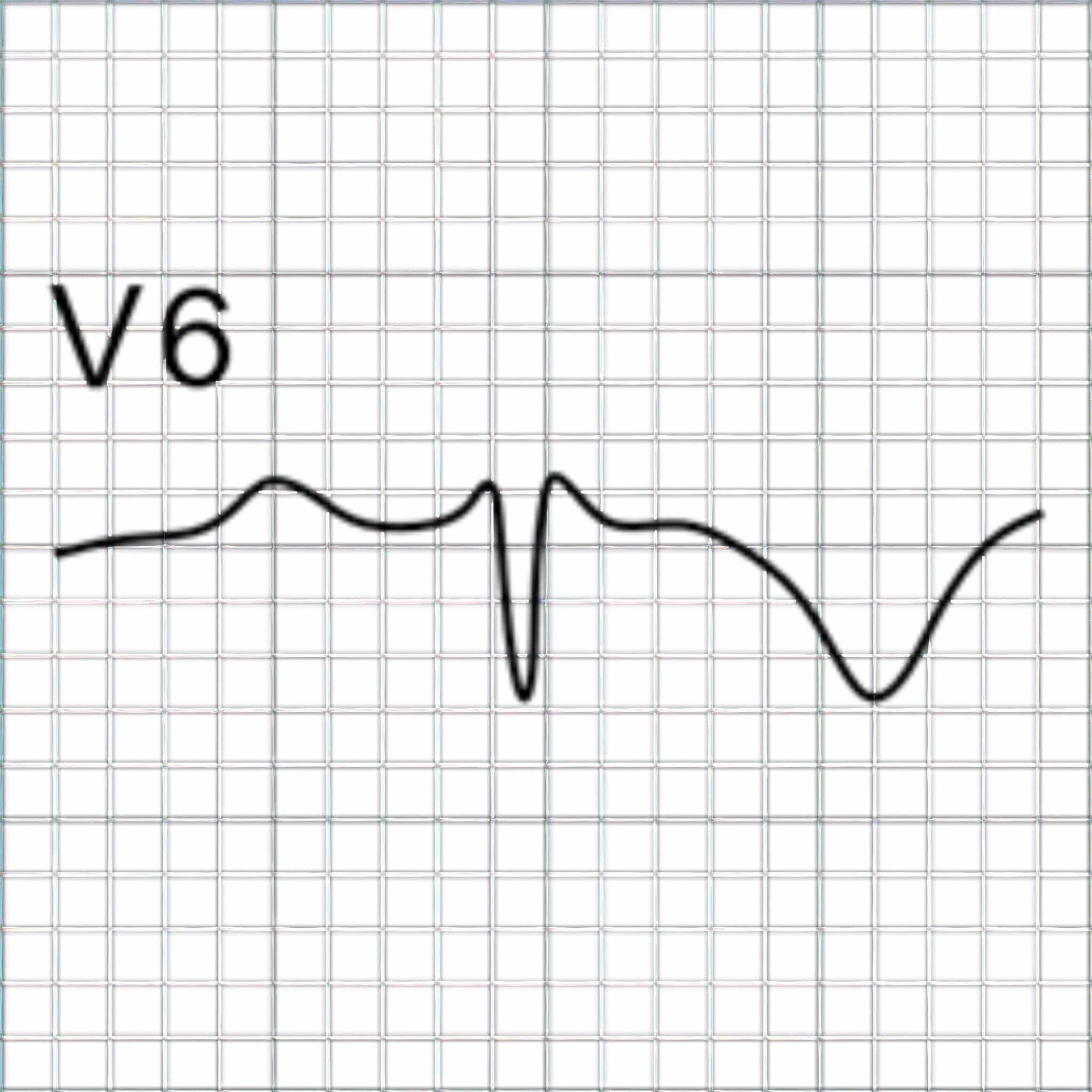 Topic - Special Infarction Patterns | 12-Lead ECG Certification Course ...