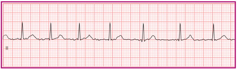 Atrial fibrillation ECG with irregular, wandering baseline.
