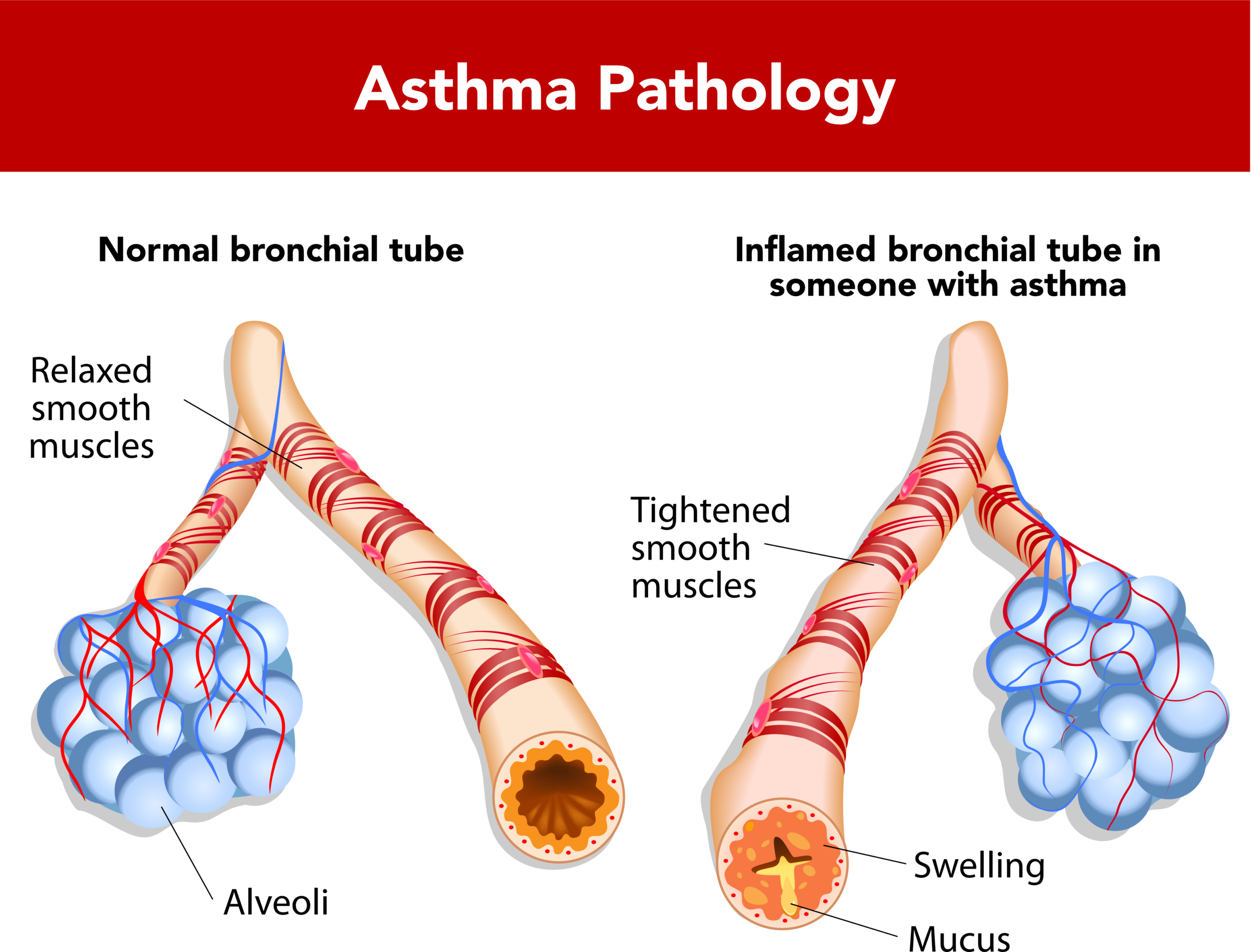Asthmatic changes.