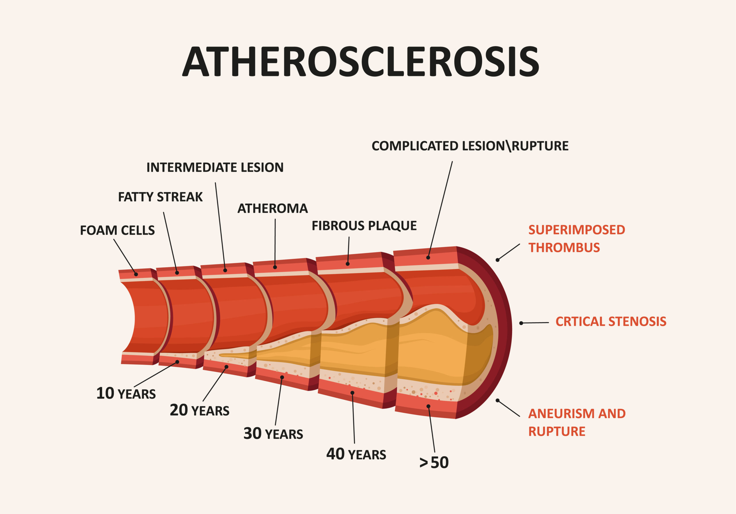 Atherosclerosis timeline.