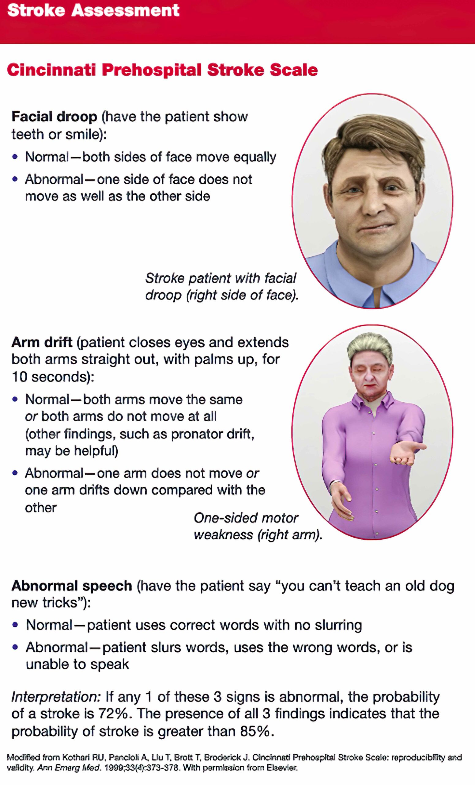 Cincinnati prehospital stroke scale.