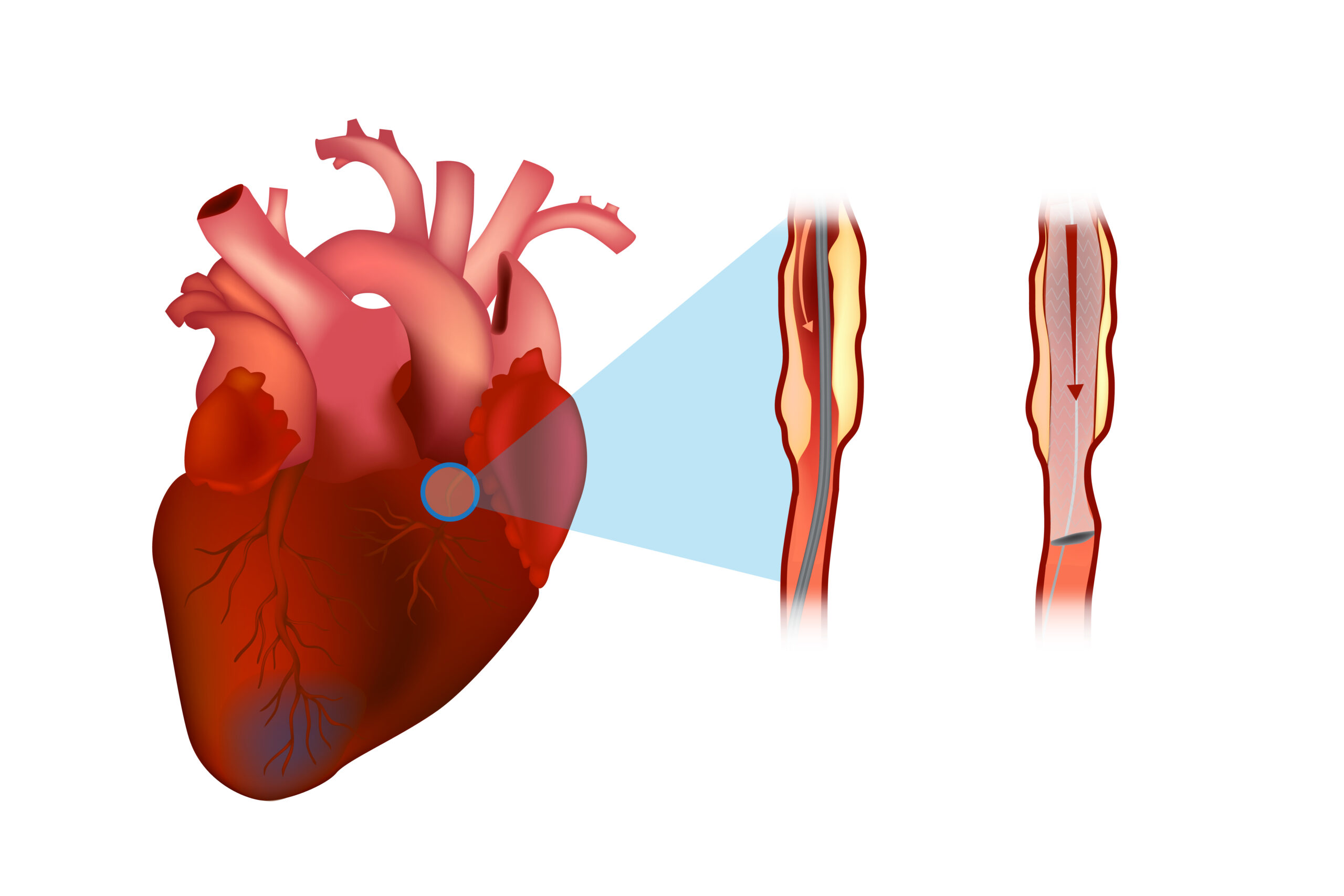 Coronary stent percutaneous cardiac intervention.
