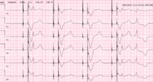 Ocfs2 Pacemaker Topic - Using Pacing | ACLS EP Course | ACLS Certification Association