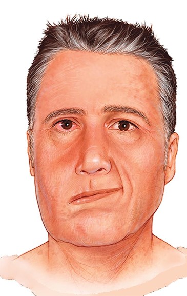 Facial droop.