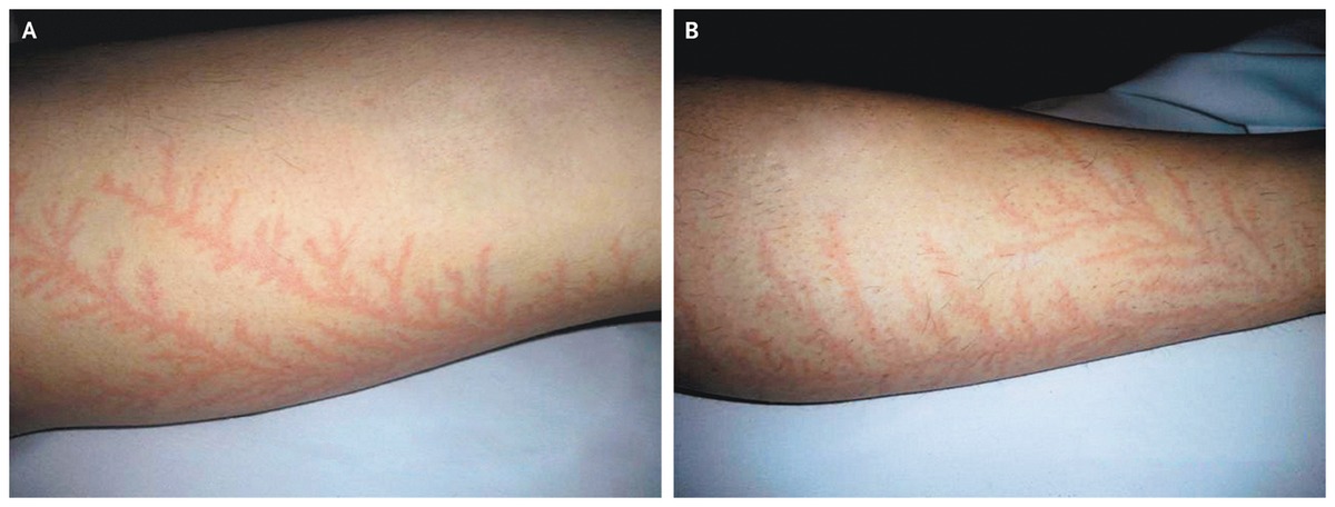 Lightning injury fern pattern.