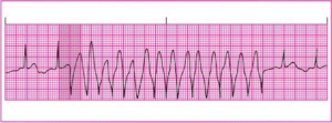 Topic - Diagnosing and Treating Tachycardias | ACLS EP Course | ACLS ...