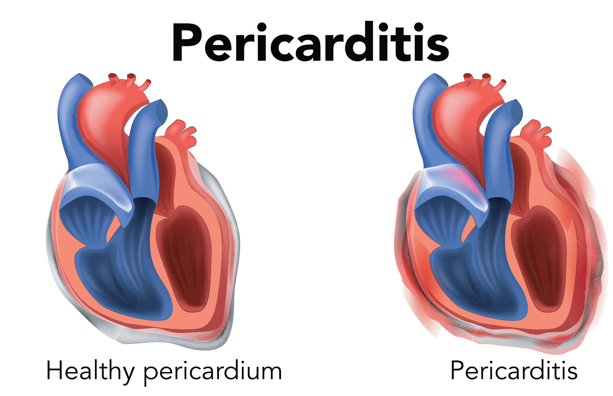 Pericarditis is pericardium inflammation.