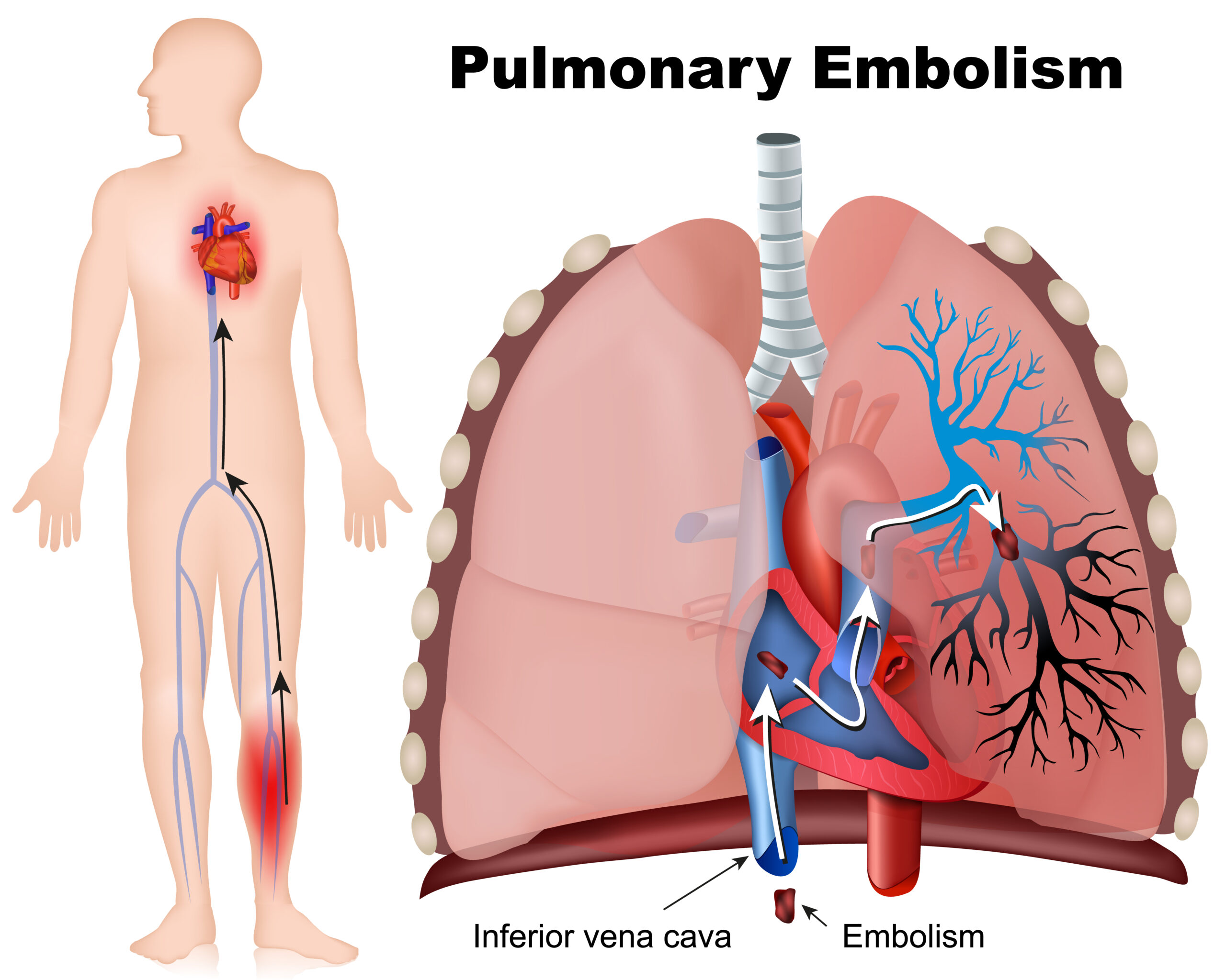 Pulmonary embolism is blood clot that travels to lungs.