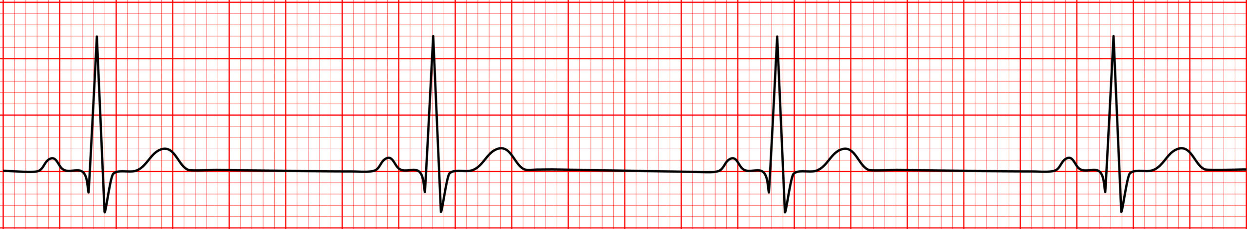 Sinus bradycardia ECG.
