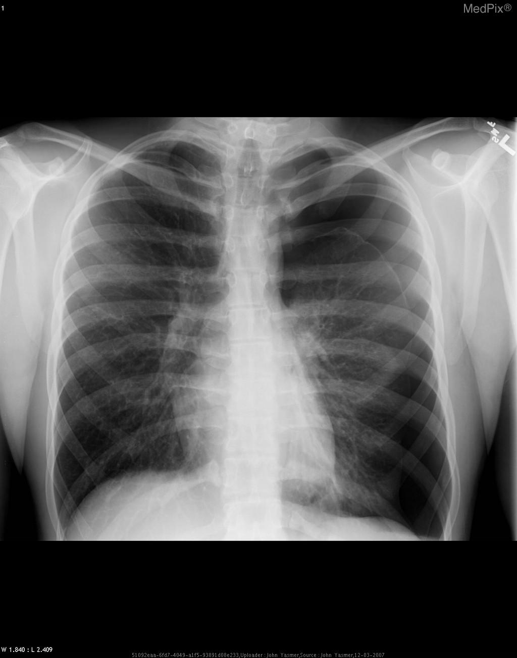 Tension pneumothorax in left lung.