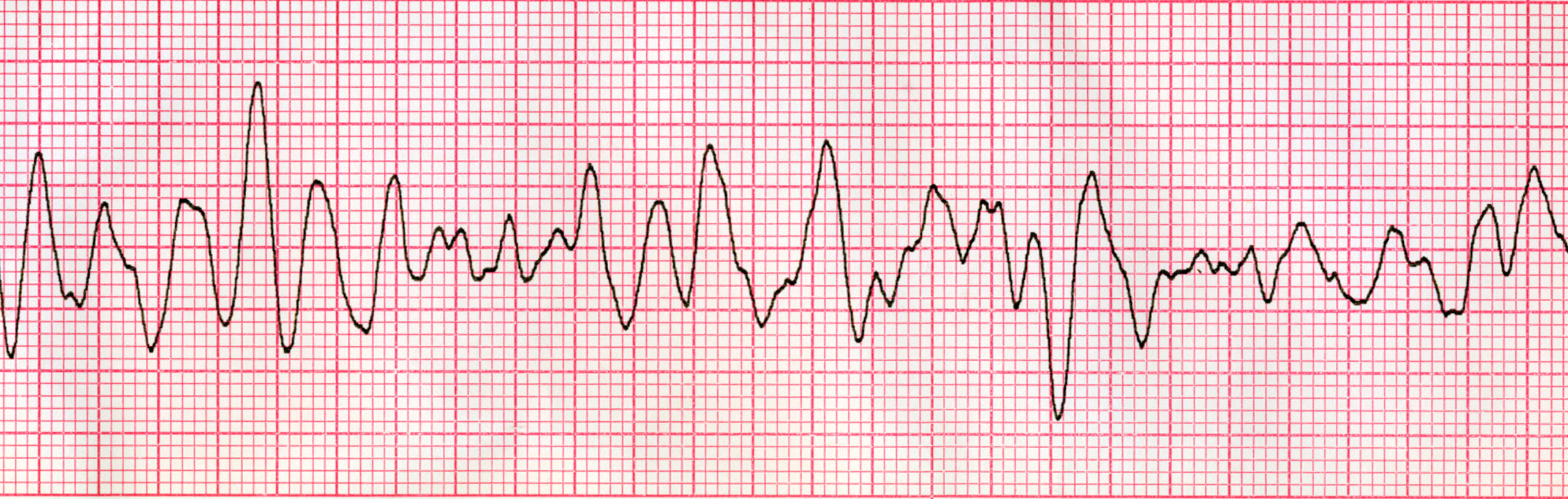 Ventricular fibrillation.