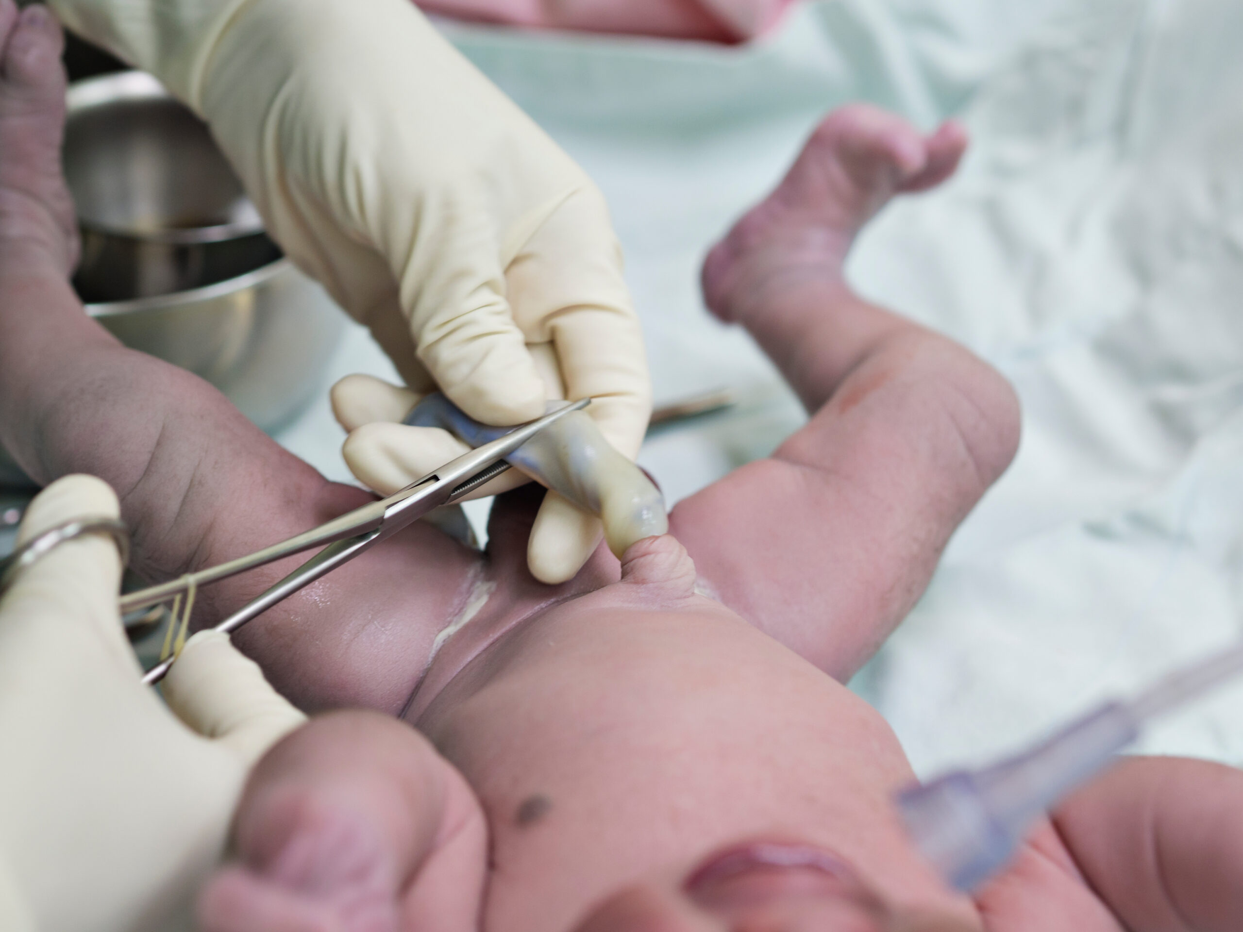 Clinician clamping an umbilical cord with hemostats.