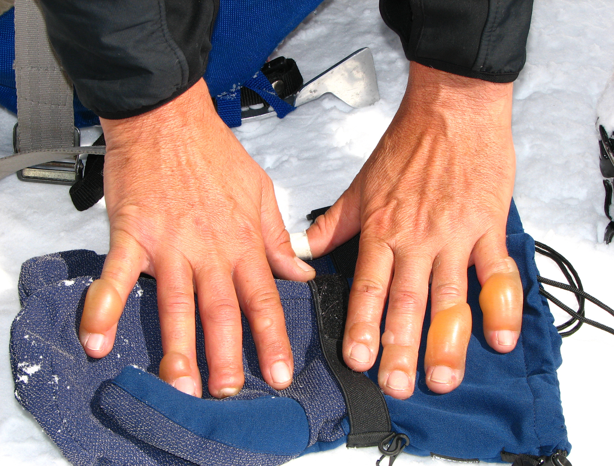 Frostbitten fingers.