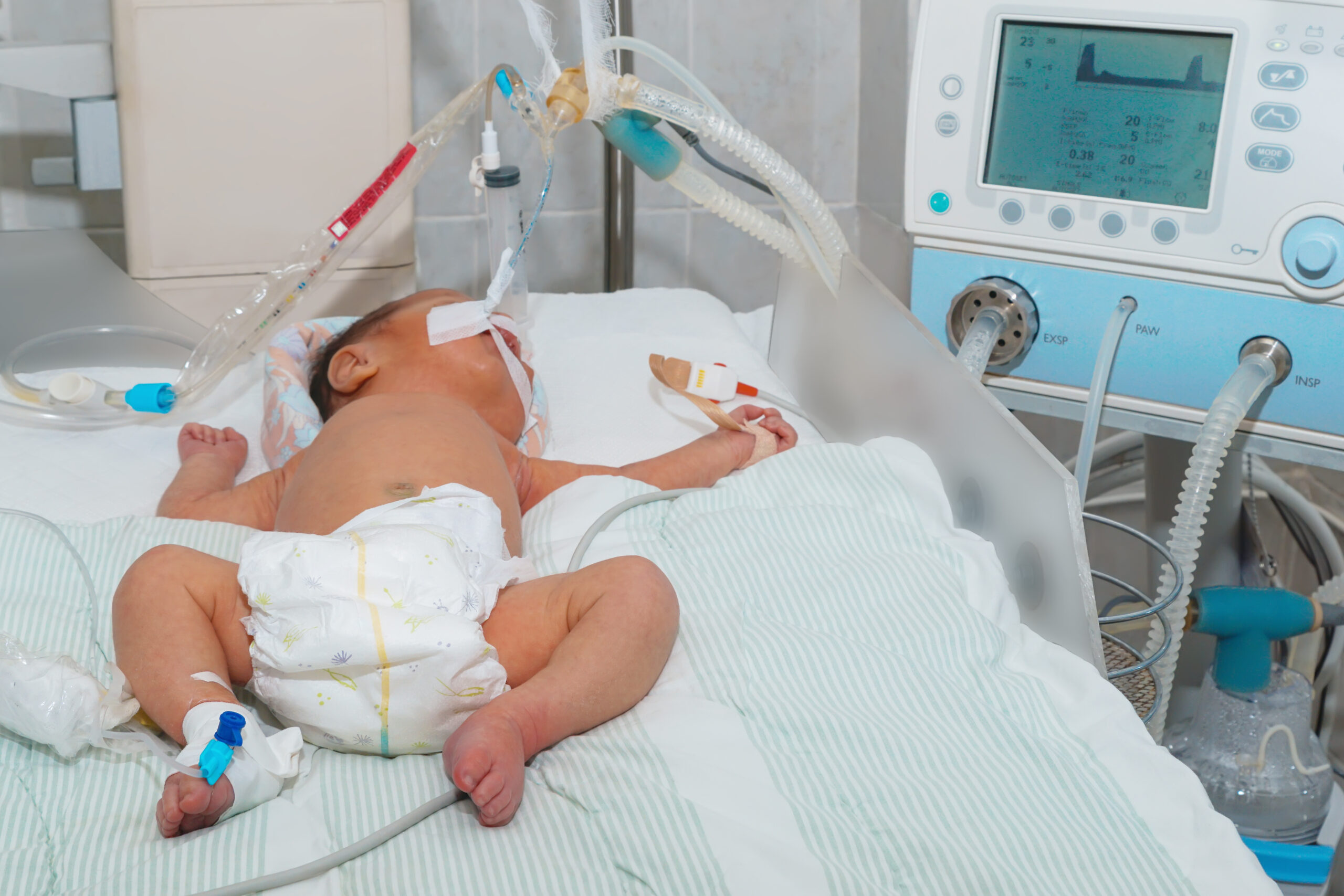 Infant wearing a diaper with an endotracheal tube secured in place.