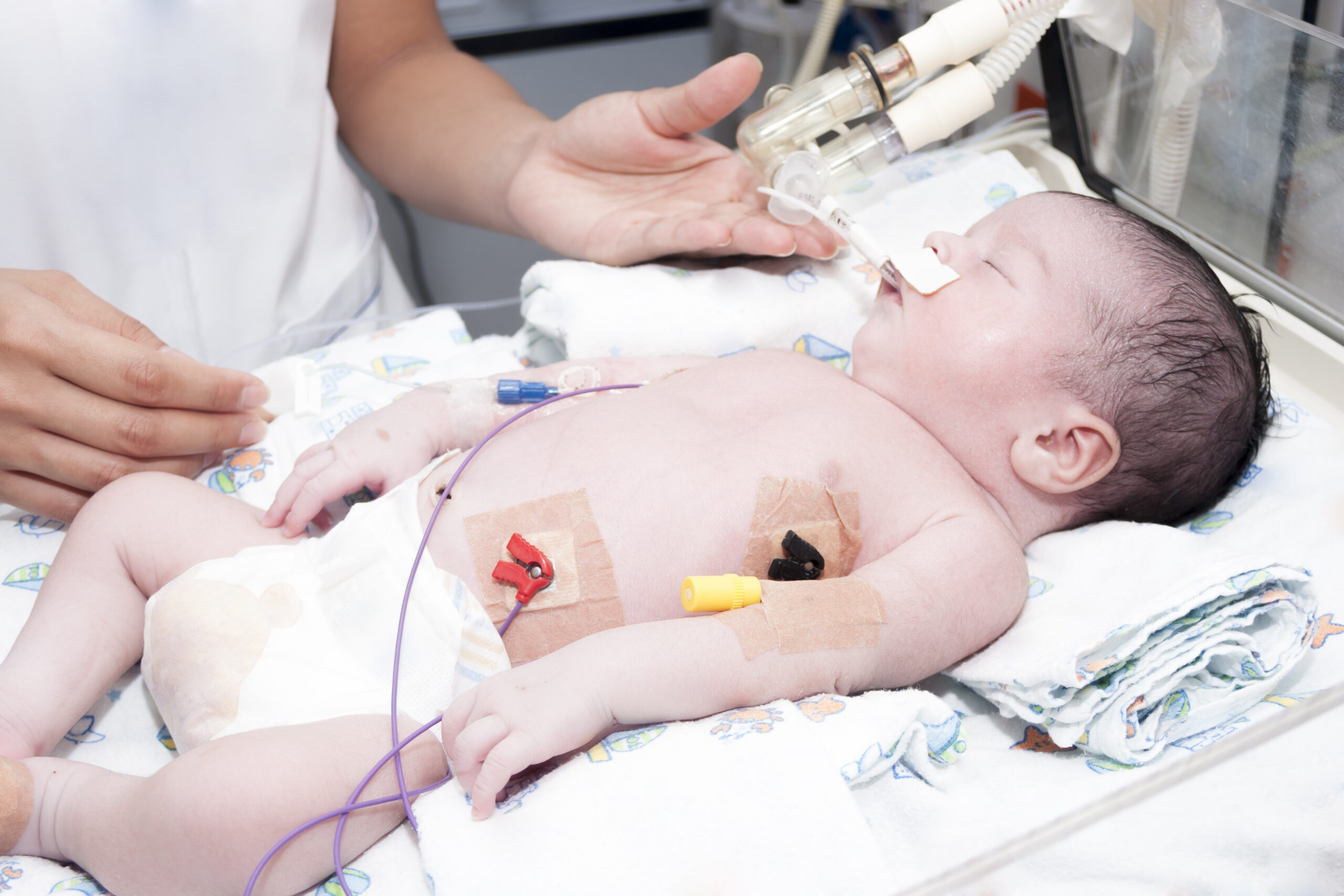 Neonate on a hospital bed with ventilation tubes.