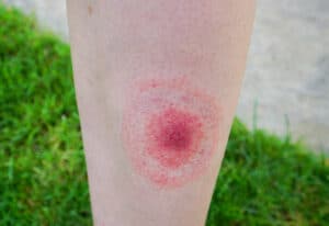 Topic - Bites and Stings | CPR, AED & First Aid Course | ACLS ...