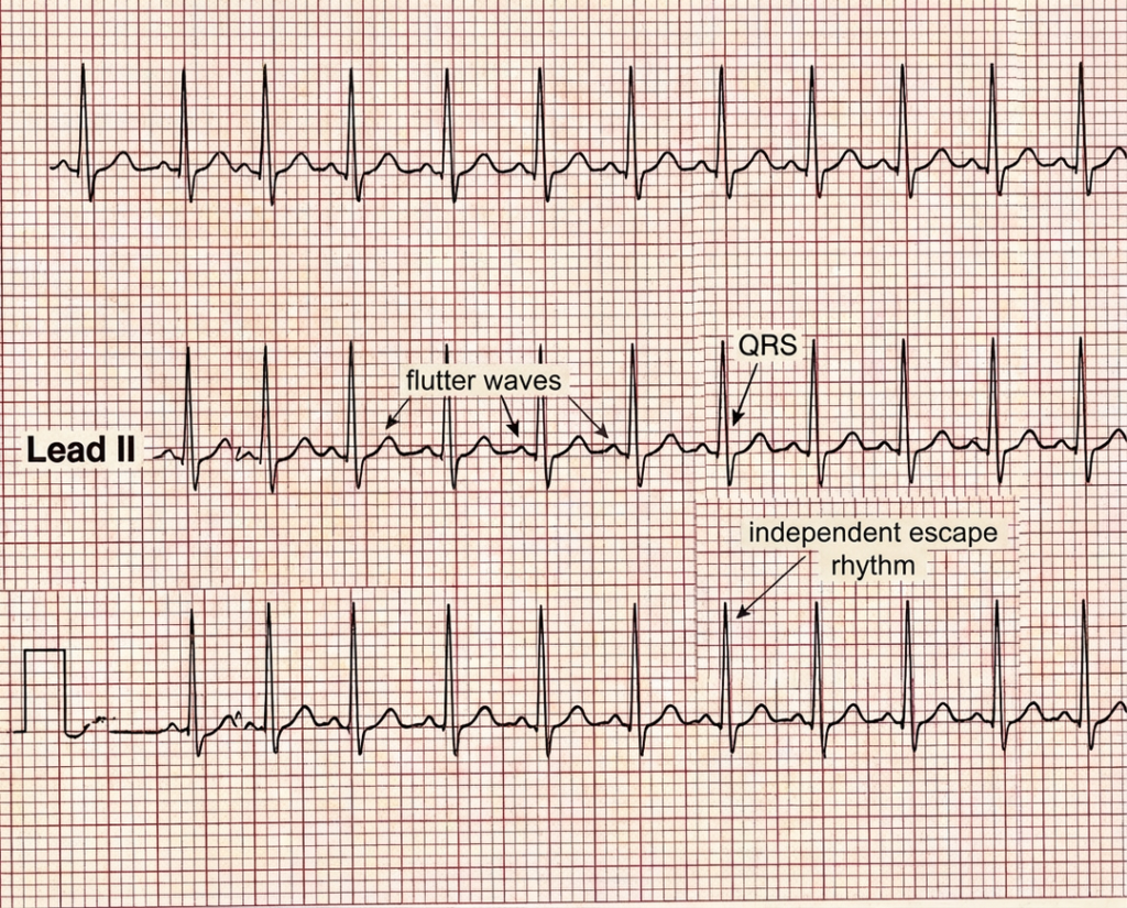 3rd degree heart block variation 3 with independent atrial flutter waves and an escape rhythm showing AV dissociation.