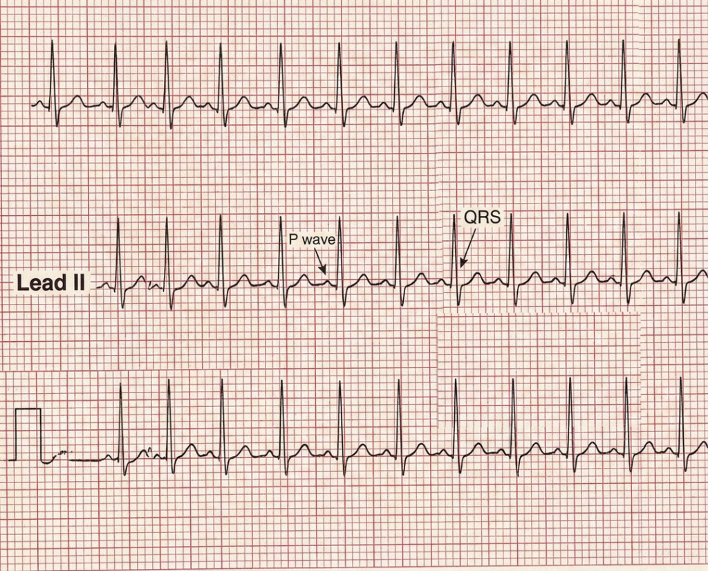 3rd degree heart block variation 1 with AV dissociation and narrow QRS junctional escape rhythm.