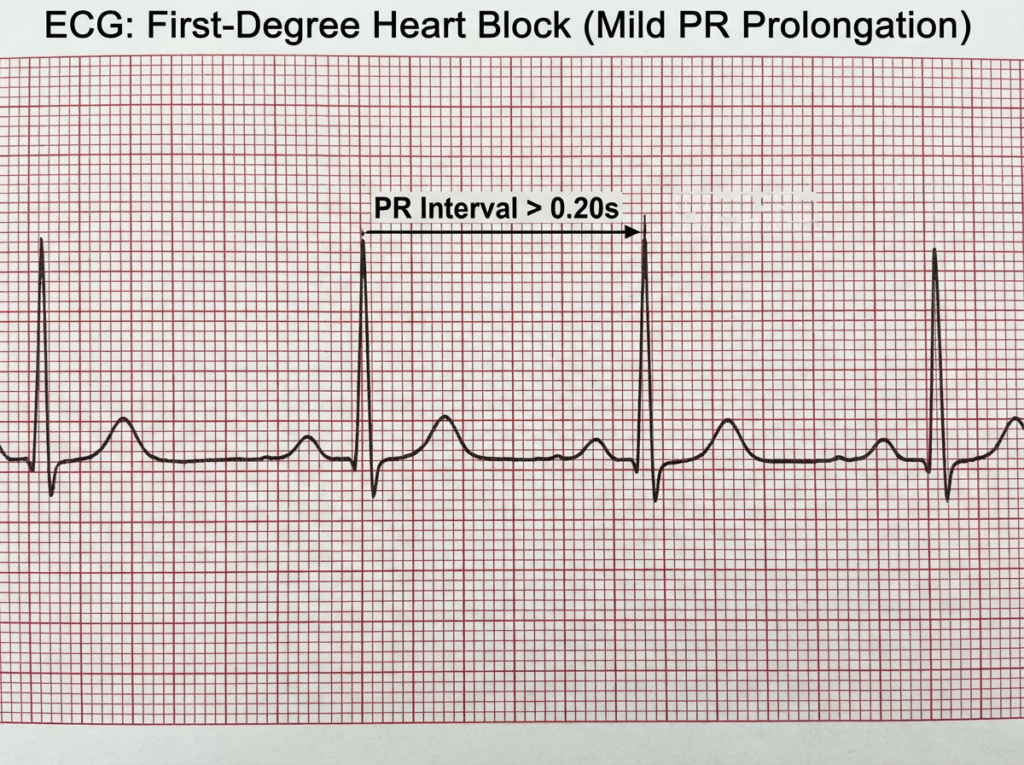 ECG strip showing first degree heart block with PR interval longer than 0.20 seconds