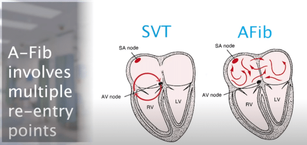 SVT Adenosine Dosing | ACLS Certification Association